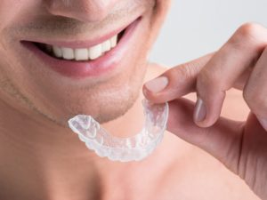 Scopri di più sull'articolo Apparecchio denti invisibile