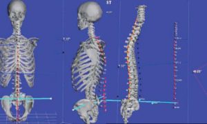 Scopri di più sull'articolo Perchè è importante effettuare un’analisi posturale tridimensionale della colonna (3D B.A.K.)