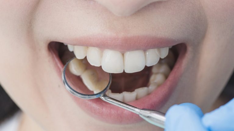 Scopri di più sull'articolo Devitalizzazione del Dente