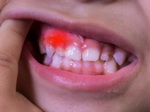 Read more about the article Denti inclusi nei bambini: cause e rimedi