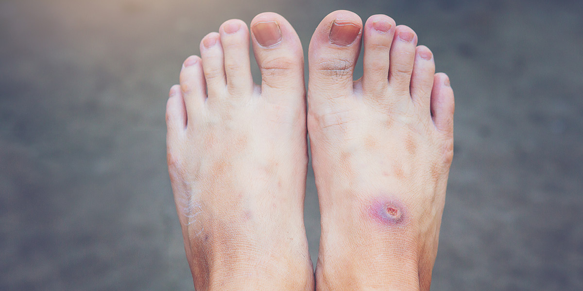 infezione del piede medical group